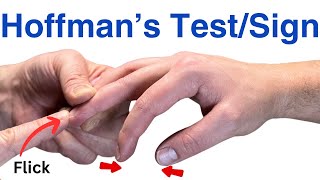 How to Perform a Hoffmans Test  Inverted Supinator Sign  Clonus  Hyperreflexia [upl. by Chaker762]