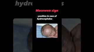 Hydrocephalus and macewen sign pediatrics hydrocephalus mbbs neetpg bighead baby neuro [upl. by Parshall]