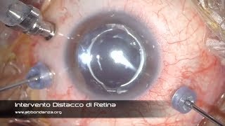 Intervento Distacco di Retina operazione distacco di retina  Dr Abbondanza [upl. by Tybalt]