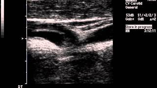 Vascular Ultrasound Acute Carotid Dissection Flap [upl. by Ruscio]