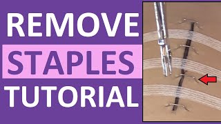 Surgical Staple Removal Nursing  How to Remove Surgical Staples [upl. by Charbonneau]