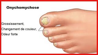 Onychomycose  quand les mycoses affectent les ongles [upl. by Siberson]