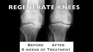 REGENERATE YOUR KNEES no surgery needed 18  httpsdrstephenstokescom [upl. by Vasta792]