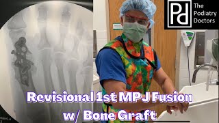 Big toe fusion with bone graft [upl. by Ocirred]