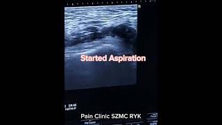 Knee joint ultrasound Guided effusion Aspiration [upl. by Lamdin283]