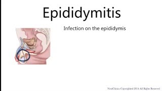 Epididymitis [upl. by Miksen]