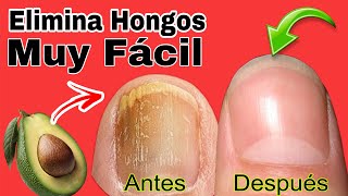 COMO Eliminar HONGOS de las UÑAS usando AGUACATE [upl. by Rengaw]