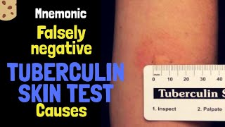 Causes of False negative PPD Skin test Mnemonic by MedSurvival [upl. by Yrrak]