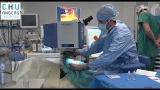 La chirurgie au laser en ophtalmologie du CHU Angers [upl. by Elatia]