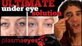 THE ULTIMATE UNDER EYE TREATMENT  PlasmaEyes [upl. by Dnumsed199]