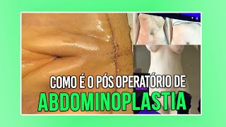 COMO É O PÓS OPERATÓRIO DA ABDOMINOPLASTIA CIRURGIA PLÁSTICA [upl. by Aicilra363]