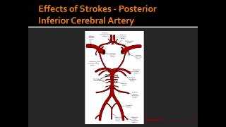 Effects of Strokes  Posterior Inferior Cerebral Artery [upl. by Aseretairam156]