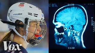 Why women’s ice hockey has a higher concussion rate than football [upl. by Sullivan559]