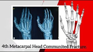 4TH METACARPAL HEAD COMMUNITED FRACTURE CRIF WITH MULTIPLE 12 K WIRES USING BOUQUET TECHNIQUE [upl. by Bopp580]