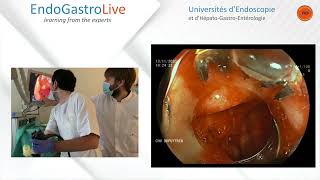 Hemostase endoscopique dun ulcère duodénal hémorragique [upl. by Hogue]