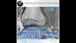 PERIOSTEAL REACTION RADIOLOGY MRI [upl. by Yren136]