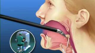 Robotic Tongue Cancer Surgery  Mayo Clinic [upl. by Yrahca441]