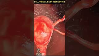 tubectomy viralvideo shortvideo hospital nursing [upl. by Ahsirk914]