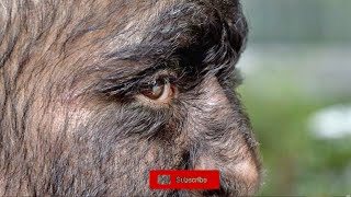 Hypertrichosis What is Werewolf Disease [upl. by Claude240]