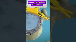 Lumbar Disc Herniation Causes Symptoms amp Treatment  Back Pain Reliefbackpain herniateddisc [upl. by Nicolai]