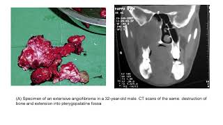 Juvenile nasopharyngeal angiofibroma Department of ENT  Santhiram Medical College [upl. by Gal]