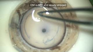 Descemet Membrane Endothelial KeratoplastyDMEK Preparation of Donor cornea [upl. by Entruoc308]