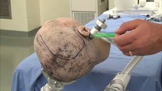 Skull Clamp Placement Large and Trauma Scalp Flaps Preview [upl. by Eddana]