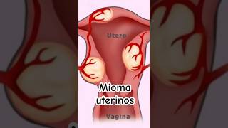 ¿Qué son los Miomas uterinos y qué síntomas producen  Dr William Guerrero medicina shorts [upl. by Ecirted44]