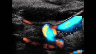 INTERNAL CAROTID ARTERY SPONTANEOUS DISSECTION [upl. by Seavir502]