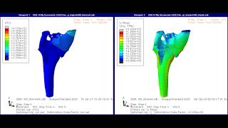 Using Abaqus to simulate additive manufacturing – Printing an optimized hip implant [upl. by Mauceri]