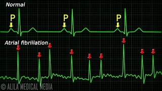 Atrial Fibrillation Anatomy ECG and Stroke Animation [upl. by Julissa]