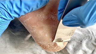 Feet callus removalampfoot scraping dead skin【Xiao Yan Pedicure】 [upl. by Anilra]