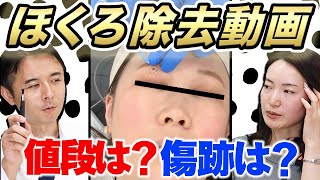 【ほくろ除去】実際の手術動画を見ながら解説！「安く・綺麗に」ほくろを取るには？ [upl. by Yaj]