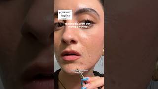 STOP SKIN PEELING FROM PRESCRIPTION RETINOID FOR ACNE ad skincare acnetreatment acneskincare [upl. by Nylassej]