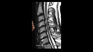 Cervical Spondylosis MRI Analysis shorts [upl. by Timothy]