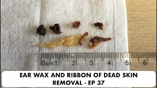 RIBBON OF DEAD SKIN AND EAR WAX REMOVAL  EP 37 [upl. by Stew89]