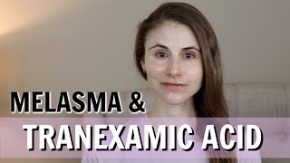 TRANEXAMIC ACID FOR MELASMA PILLS CREAMS INJECTIONS DR DRAY [upl. by Vaios]