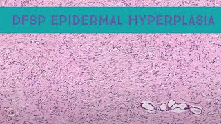 DFSP mimicking dermatofibroma dermatofibrosarcoma with epidermal induction amp collagen trapping [upl. by Suirtemed672]