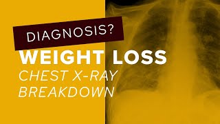 Chest XRay breakdown how to deal with multiple cavitating lung lesions [upl. by Weider287]