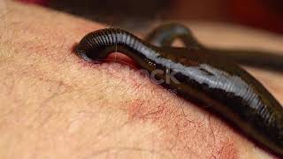 Medical leeches on the human body drink blood Treatment with leeches [upl. by Waki]