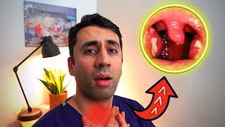 What Causes a Sore Throat HOME Remedies and Cures for Fast TREATMENT Doctor Explains [upl. by Kathrine]