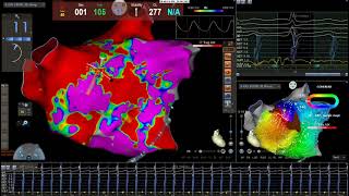 Left atrial flutter ablation par le Dr Franck Halimi Rythmologue Paris [upl. by Nyleahcim]