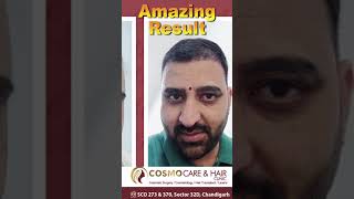 Amazing Hair Transplant Transformation  Before amp After Results  Hair Transplant in Chandigarh [upl. by Oneg4]