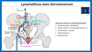 Lymphabfluss beim Zervixkarzinom  Strahlentherapie Prof Hilke Vorwerk [upl. by Artcele247]