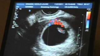 Ultrasound  7weeks 5 days Pregnant [upl. by Lemon547]