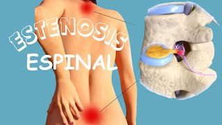 Estenosis espinal  Descompresión lumbar totalmente endoscópica con estenosis VERTEBRAL [upl. by Llaccm467]