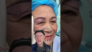 Unconventional Blepharoplasty  Plastic Surgeon Reacts [upl. by Salaidh474]