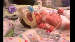 BABY BORN AT 26 WEEKS [upl. by Genevra265]