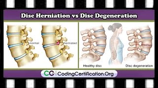 HCPCS and CPT Codes FAQs  Disc Herniation vs Disc Degeneration [upl. by Naerad]