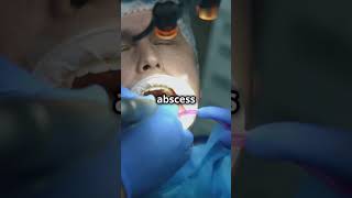 What Happens to The Abscess After Tooth Extraction  Dental Abscess  Daily Dentists [upl. by Oona529]